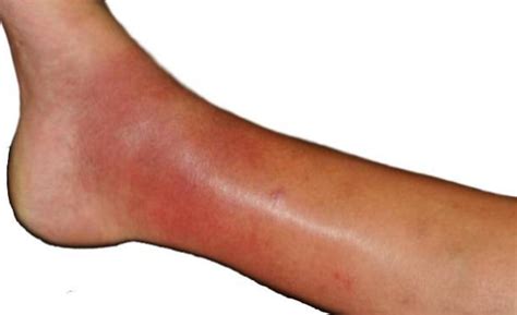 cellulitis  symptoms risks diagnosis treatment home