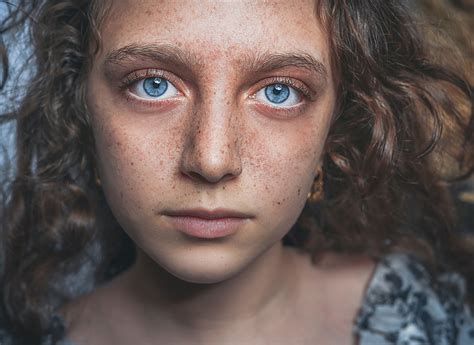 Гиперпигментация – что делать?