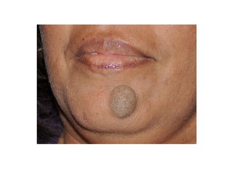 Case Study: Removal of A Large Chin Mole - Explore Plastic Surgery