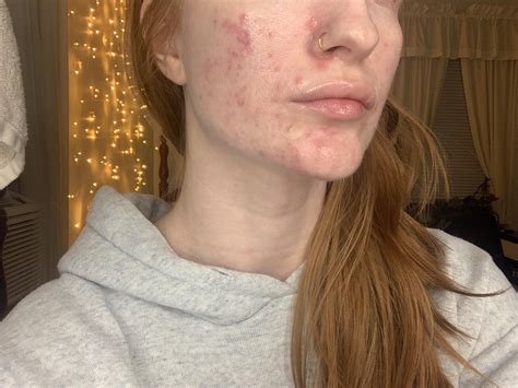 Diagnosed with inflamed cystic acne : r/acne