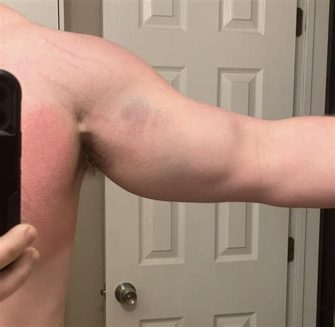 Torn Pectoral Tendon? : r/medical_advice