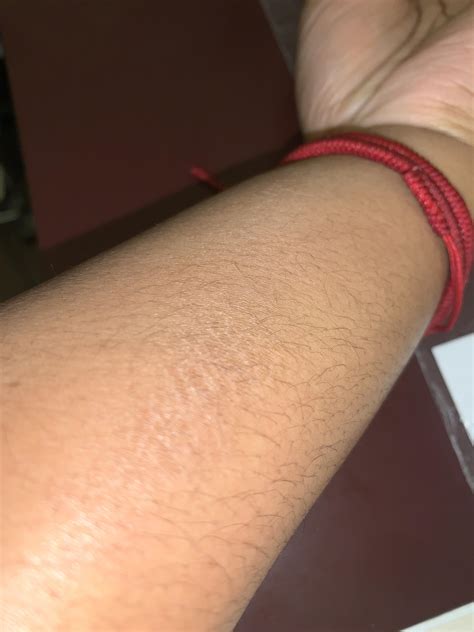 Scaly rash appeared on skin : r/skincancer