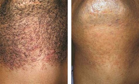 Men's Laser Hair Removal Boca Raton | IconMD