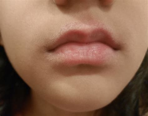 Dry Skin Rash On Lips - Infoupdate.org