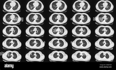 Computed tomography of the lungs in a healthy adult man. Normal lungs ...