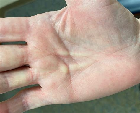 OrthoDx: Firm Nodule on Palm of Hand