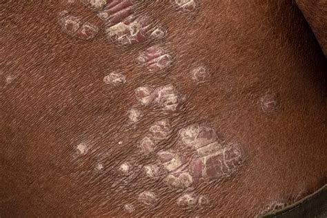 How Does Psoriasis Affect People of Color?