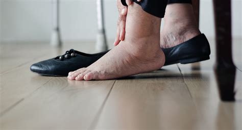 How to Treat Swollen Feet and Ankles and Legs?
