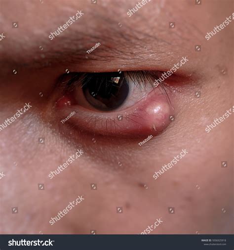Chalazion Hordeolum Stye Eye Disorders Stock Photo 1836925918