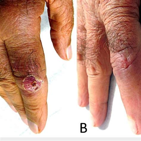 (PDF) Cutaneous Mycobacterium Marinum Infection (Fish Tank Granuloma ...