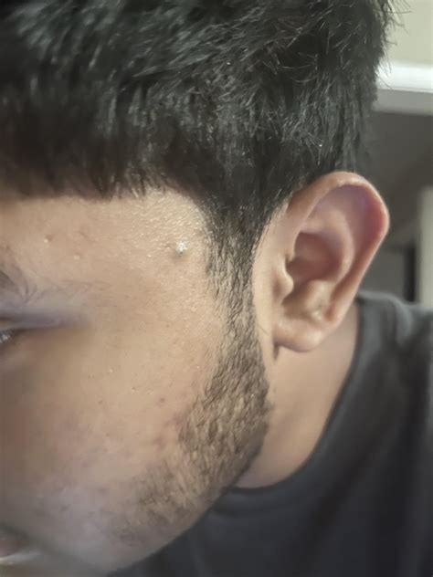 Very Large Blackhead Removal By Dermatologist Best At Home Blackhead