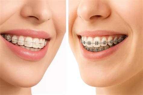 clear braces cost benefits  care tips  india