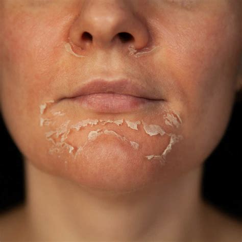 Peeling Skin: Everything You Need To Know - Vie Aesthetics
