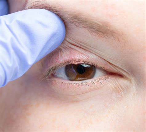 eyelid lumps  bumps dr cutler peck