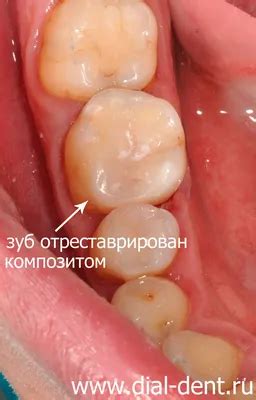 [36+] Пульпит фото