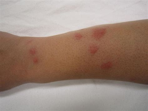 Bed bug bites: Pictures, treatment, and prevention
