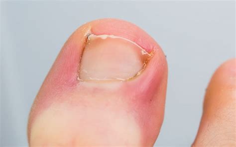 5 Ways To Heal Your Infected Toenail Nightmare