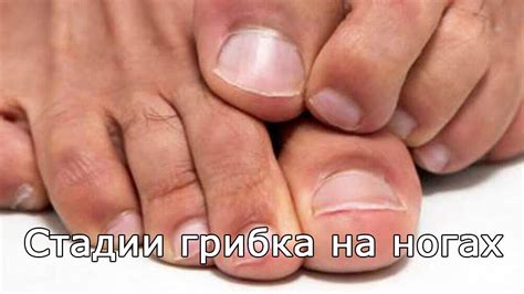 Кожный грибок на ногах фото