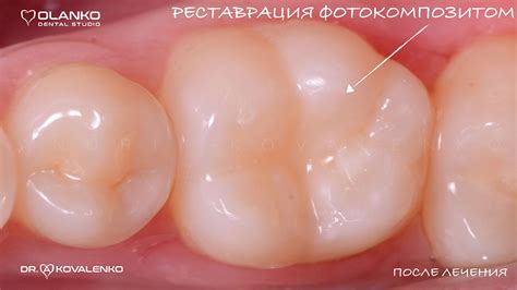 Фотополімерна реставрація зубів Київ, Бровари - ціна, фото