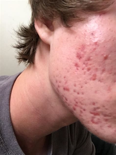 How Severe is my acne, and What can be Done to Help it? – Acne – Acne