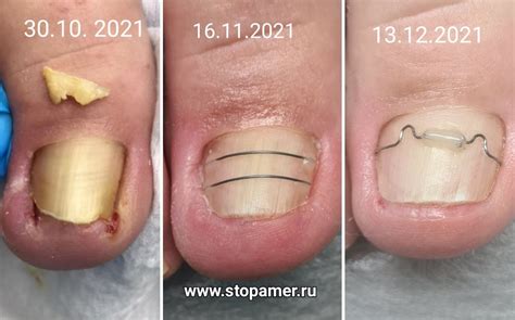 Лечение, удаление вросшего ногтя без хирургии — Центр подологии в ...