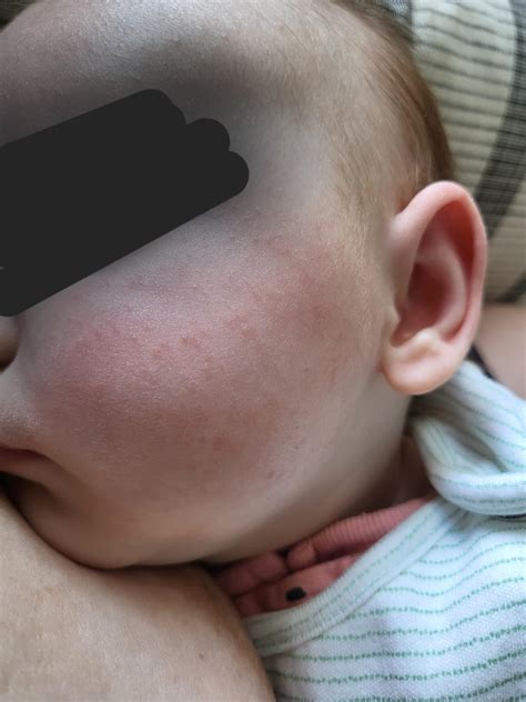 Thoughts on rash on cheeks? : r/Mommit