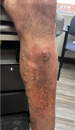 Understanding Phlebitis: Causes, Symptoms, and Treatment