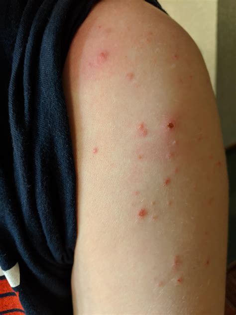 how to get rid of shoulder pimples 1