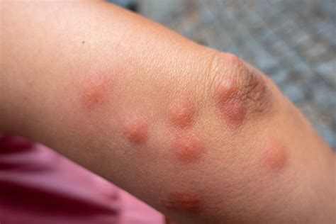 whats  difference  flea bites  bed bug bites