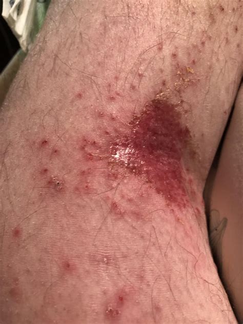 Does this look like scabies? : r/scabies