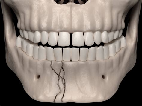 CE Activity | Mandible Fracture | NPs
