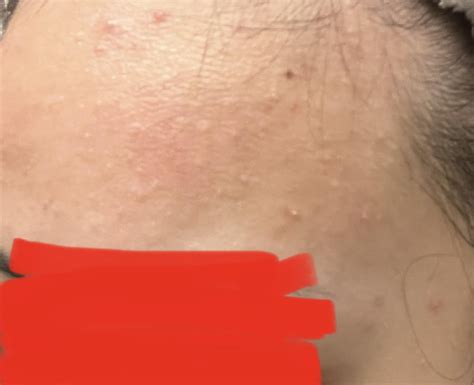 Please help!! Bumpy acne? : r/acne