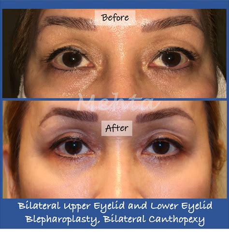 Dark Circles And Bags Under Eyes Causes at Bobby Gibson blog