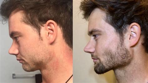 What Is Mewing? A Guide To The Jaw Exercise Technique
