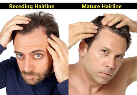 Receding Hairline: Causes, Treatments, And Coping Strategies
