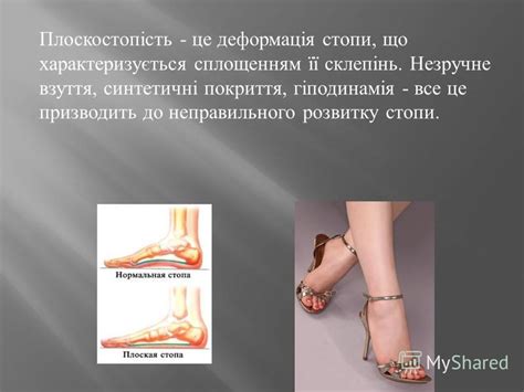 Презентация на тему: "Плоскостопість ". Скачать бесплатно и без ...