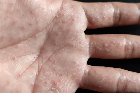Dyshidrotic Eczema Treatment