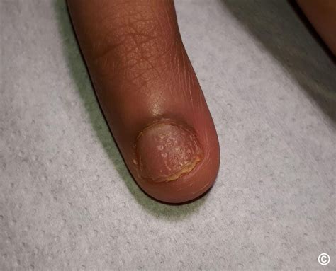 Nail psoriasis