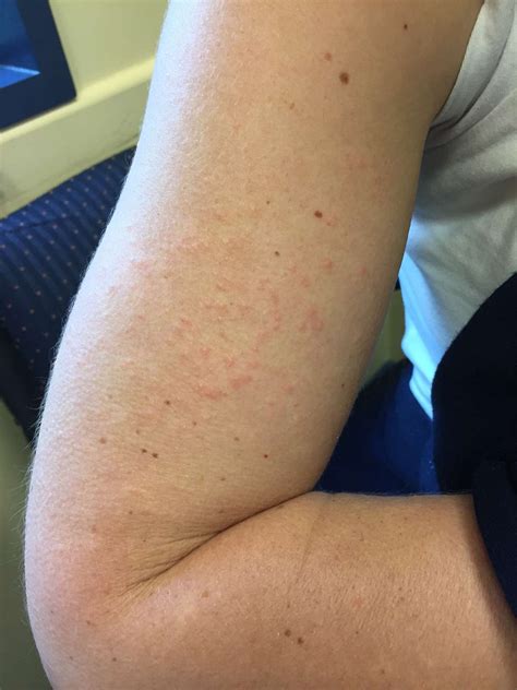 Itchy Bumps On Arms