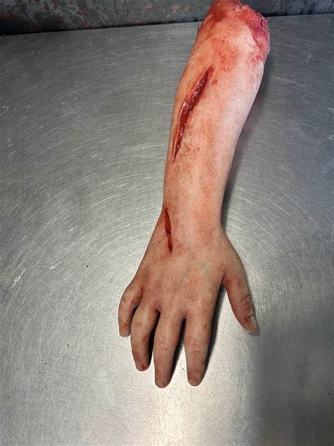 Broken Arm Bone Sticking Out