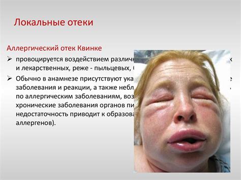 Отечный синдром - презентация онлайн