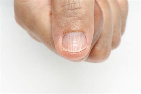 Do Vitamin Deficiencies Cause Fingernail Ridges? | livestrong