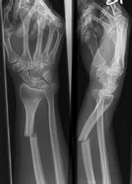 Open and Closed Fractures - Anatomy: Fracture Tutorial