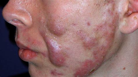 Acne Has Met Its Arch Nemesis With These Tips! - PC Video Games, Online ...