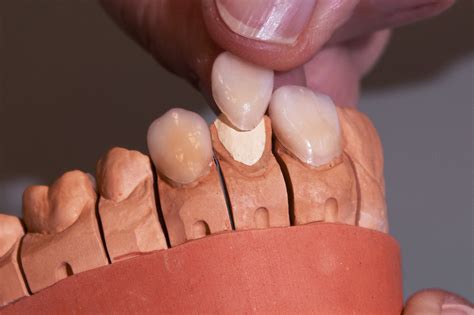 Fixing Gel | Yeti Dental