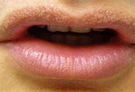 What Causes Fordyce Spots & Where Do They Develop?