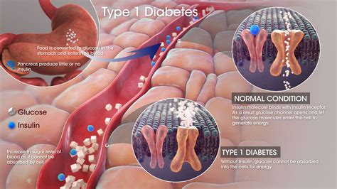 Type 1 Diabetes - Scientific Animations