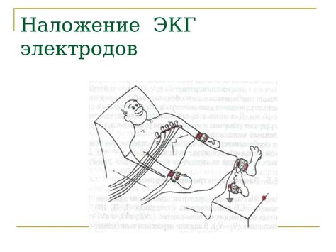 Как делают экг: техника наложения и снятия электродов, как снимают и ...