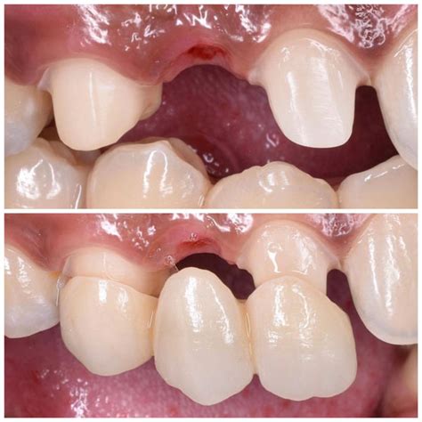 Dental Bridge Before And After