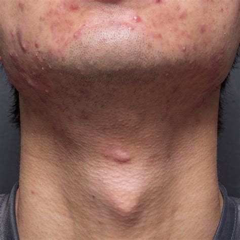 Back Neck Acne Treatment at Donna Willey blog